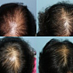 Сыворотки Останавливающие выпадение волос и стимулирующие новый рост спящих фолликул.